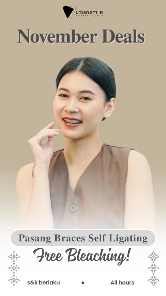 promo behel selfligating dapat free bleaching