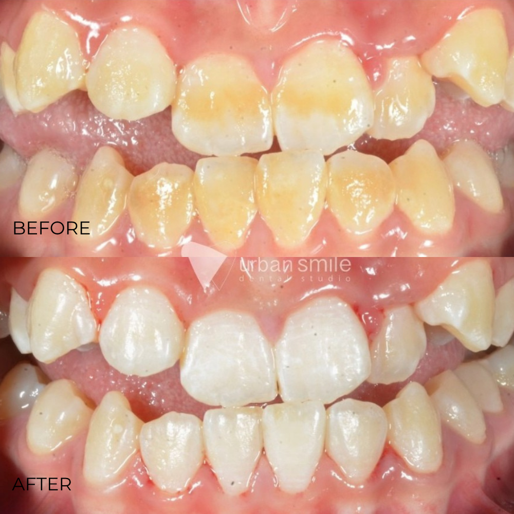 Bleaching malang