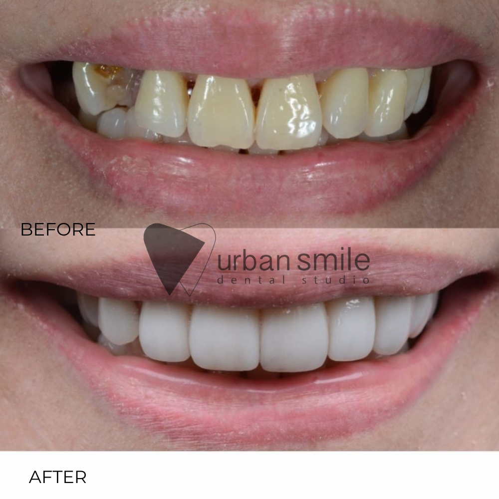 Veneer malang