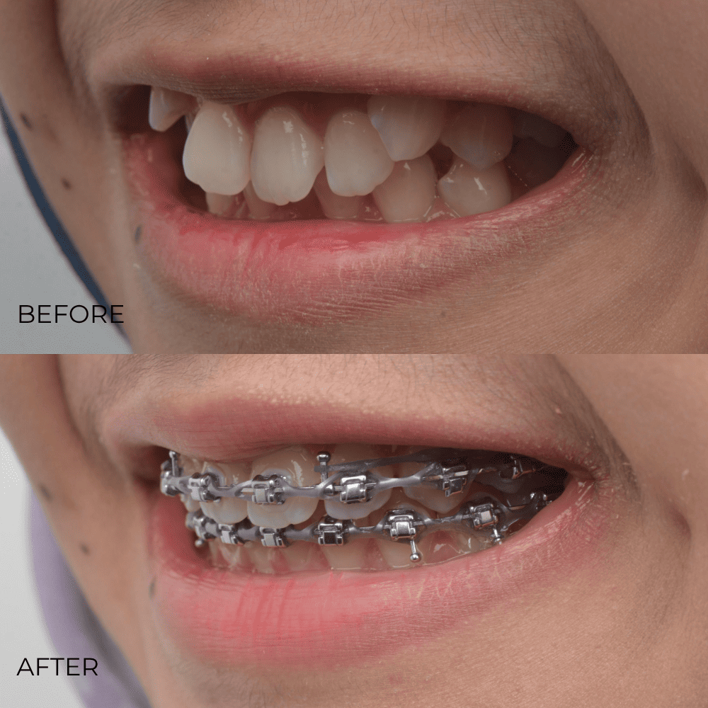 braces