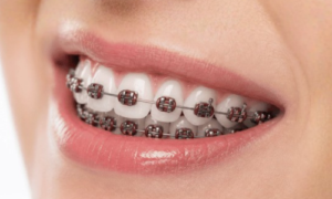 Braces