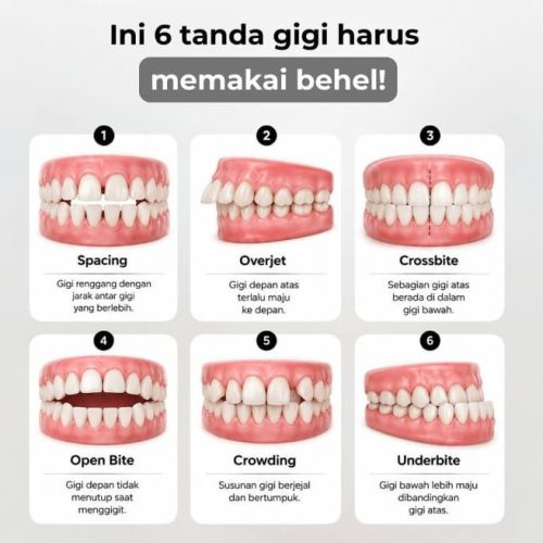 6 Tanda Gigi Harus Memakai Behel!